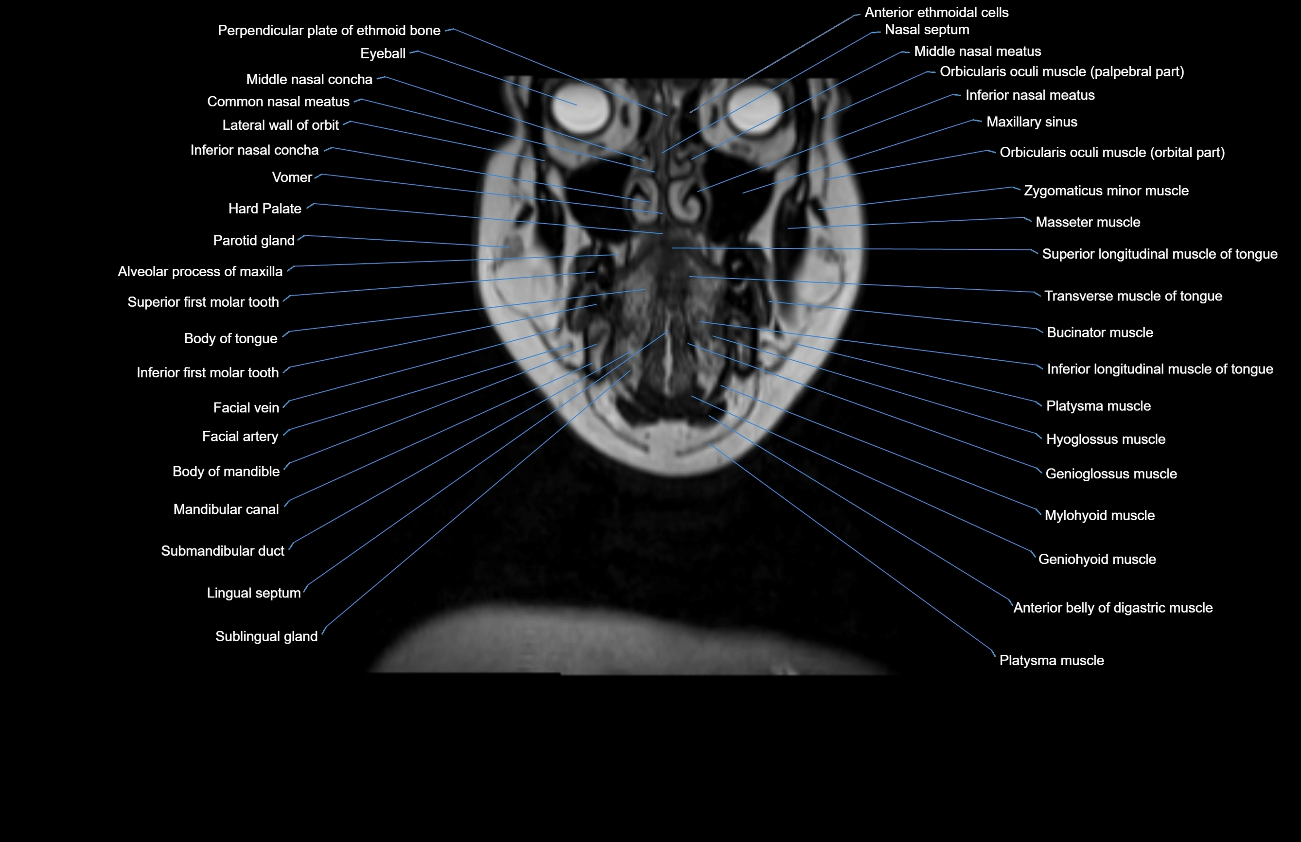 Neck coronal cross sectional MRI anatomy 3T MRI  image-img-00001-00062.webp